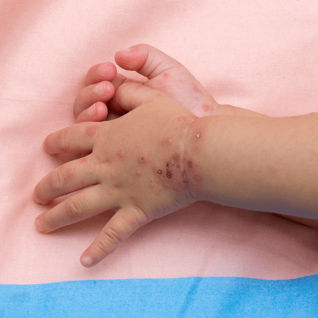 Hand, Foot and Mouth Disease: What’s Causing the Outbreak?