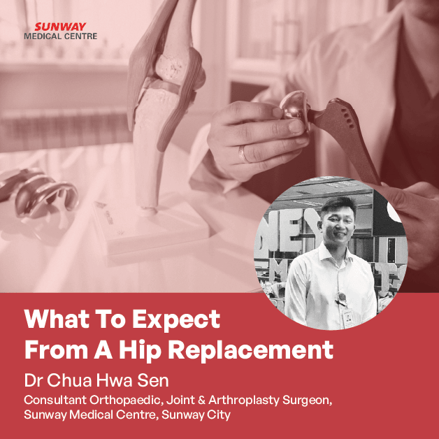 What To Expect From A Hip Replacement