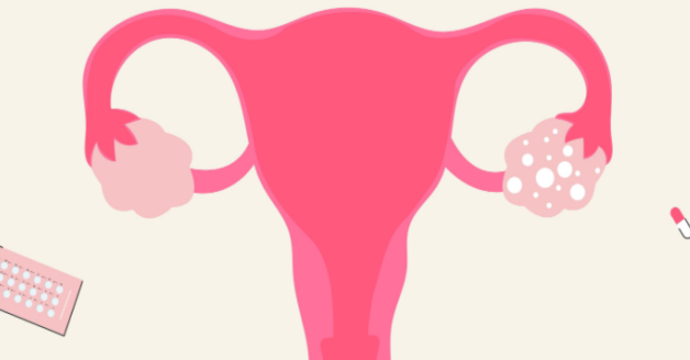 Understanding PCOS and How It Affects Women’s Bodies 