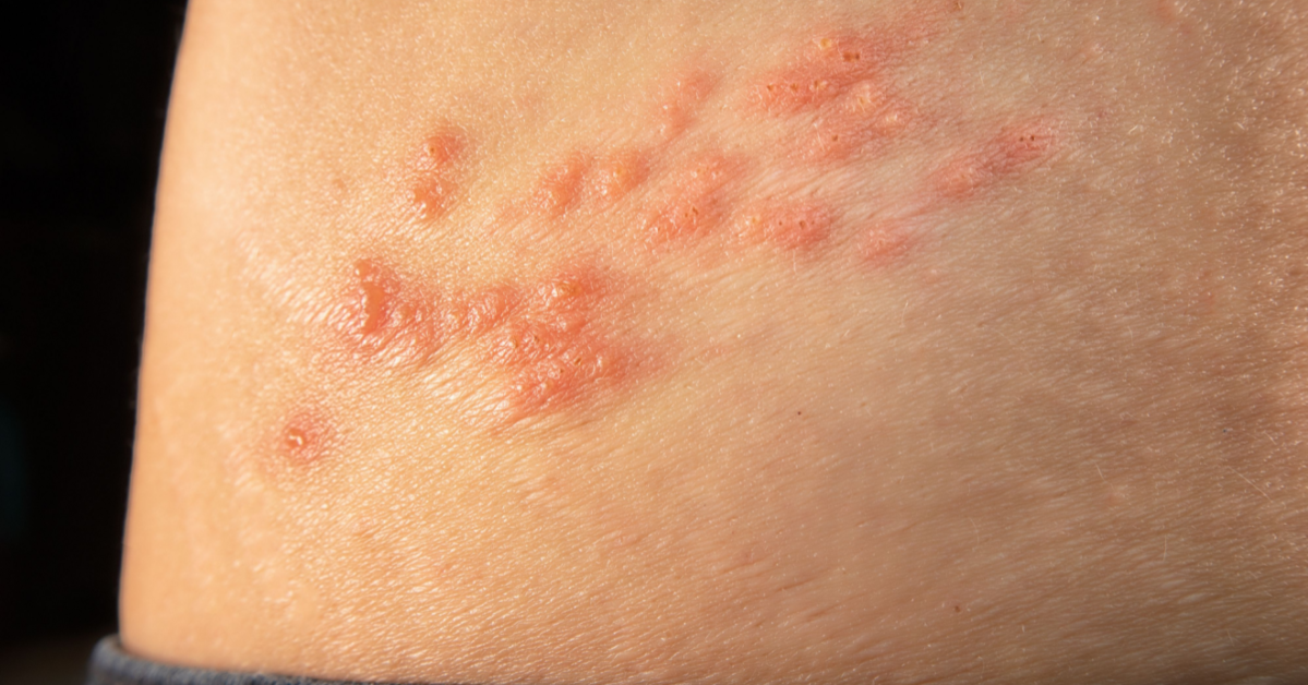 Doctor in the House: What You Should Know About Shingles 