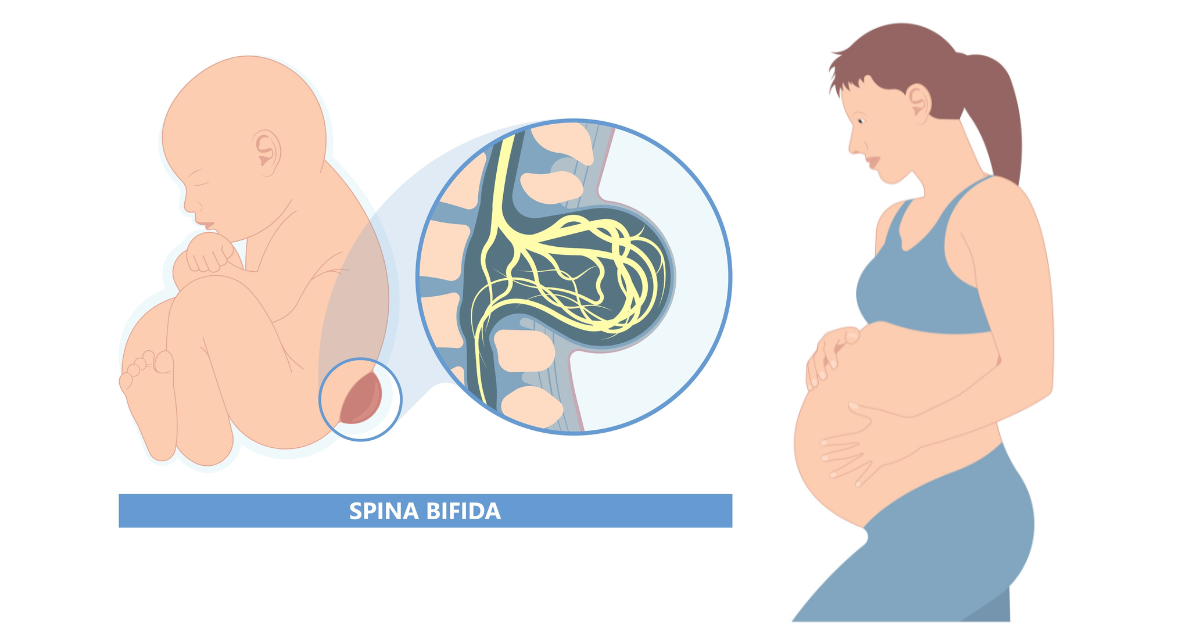In-Womb Surgery for Babies with Spina Bifida
