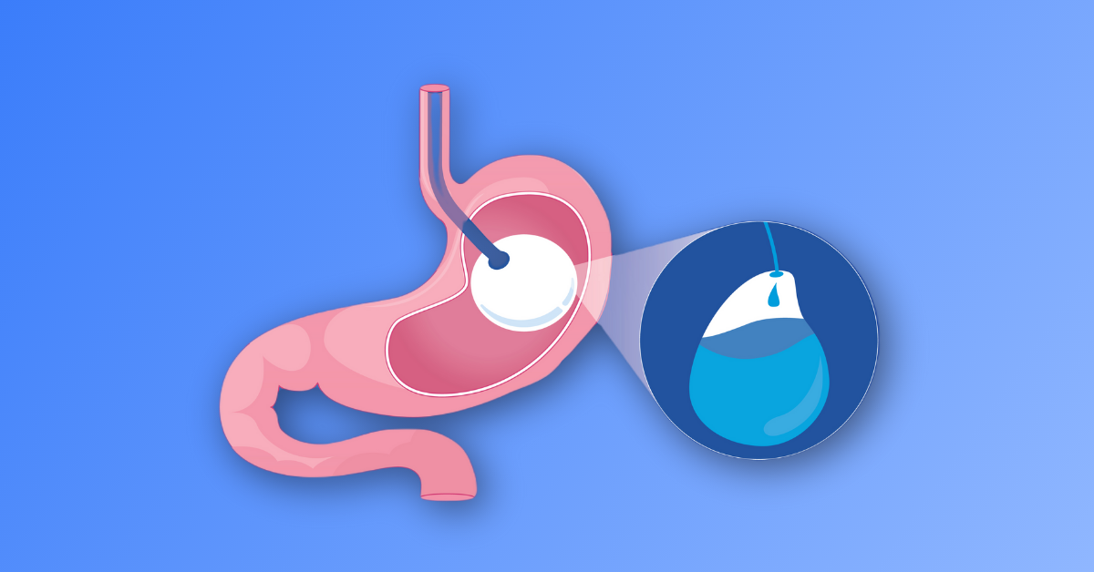 What Do Intragastric Balloons Offer In Obesity Management?