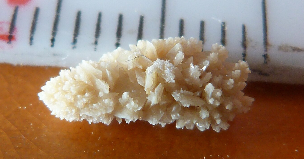 Ouch! Kidney Stones Again?