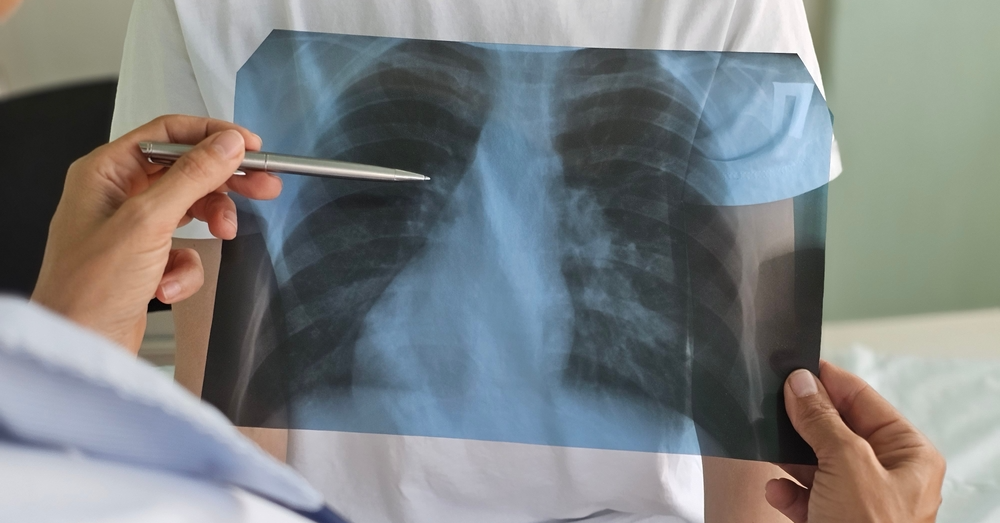 Public Health: Progress in Lung Cancer Care