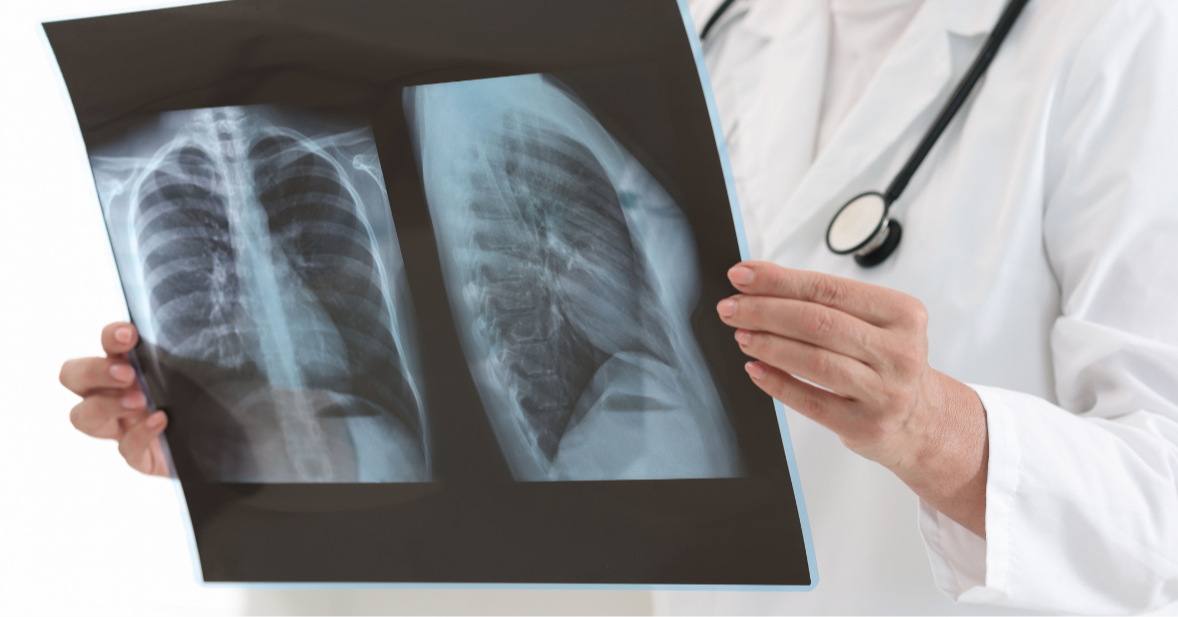 Malaysia on TB Watch