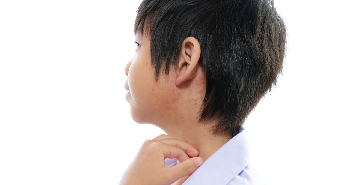 Top 5 at 5: Measles Surge in Southeast Asia